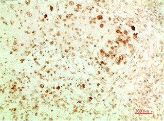 Immunohistochemical analysis of paraffin-embedded Human Ovarian Carcinoma Tissue using ATG5 Mouse mAb diluted at 1:200.Mouse anti-Human ATG5 Monoclonal Antibody
