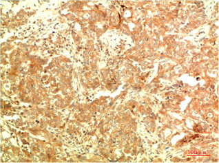 Immunohistochemical analysis of paraffin-embedded Human Breast Carcinoma Tissue using ATG5 Mouse mAb diluted at 1:200.Mouse anti-Human ATG5 Monoclonal Antibody