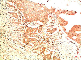 Immunohistochemical analysis of paraffin-embedded Human Breast Carcinoma Tissue using Acetyl P53(K382) Mouse mAb diluted at 1:200.