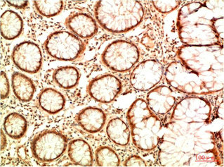 Immunohistochemical analysis of paraffin-embedded Human Colon Carcinoma Tissue using Acetyl P53(K382) Mouse mAb diluted at 1:200.