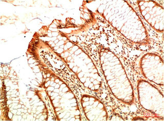 Immunohistochemical analysis of paraffin-embedded Human Colon Carcinoma Tissue using Acetyl P53(K382) Mouse mAb diluted at 1:200.