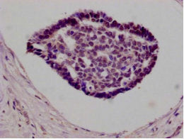 IHC image of NFE2L2 Monoclonal Antibody diluted at 1:100 and staining in paraffin-embedded human breast cancer tissue performed on a Leica BondTM system. After dewaxing and hydration, antigen retrieval was mediated by high pressure in a citrate buffer (pH 6.0). Section was blocked with 10% normal goat serum 30min at RT. Then primary antibody (1% BSA) was incubated at 4°C overnight, and detected by a Goat anti-mouse IgG polymer labeled by HRP and visualized using 0.05% DAB.Mouse anti-Human NFE2L2 Monoclonal antibody