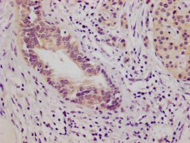 IHC image of NFE2L2 Monoclonal Antibody diluted at 1:100 and staining in paraffin-embedded human pancreatic cancer tissue performed on a Leica BondTM system. After dewaxing and hydration, antigen retrieval was mediated by high pressure in a citrate buffer (pH 6.0). Section was blocked with 10% normal goat serum 30min at 37℃. Then primary antibody (1% BSA) was incubated at 4°C overnight. The primary is detected by a Goat anti-mouse IgG labeled by HRP and visualized using 0.05% DAB.Mouse anti-Human NFE2L2 Monoclonal antibody