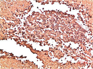 Immunohistochemical analysis of paraffin-embedded Human Lung Carcinoma Tissue using Collagen II Mouse mAb diluted at 1:200Mouse anti-Human COL2A1 Monoclonal Antibody