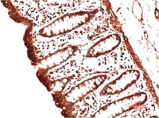 Immunohistochemical analysis of paraffin-embedded Human Colon Carcinoma Tissue using Collagen II Mouse mAb diluted at 1:200Mouse anti-Human COL2A1 Monoclonal Antibody