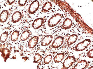 Immunohistochemical analysis of paraffin-embedded Human Colon Carcinoma Tissue using Collagen II Mouse mAb diluted at 1:200Mouse anti-Human COL2A1 Monoclonal Antibody