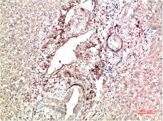 Immunohistochemical analysis of paraffin-embedded Human Liver Carcinoma Tissue using TTR Mouse mAb diluted at 1:200Mouse anti-Human TTR Monoclonal Antibody