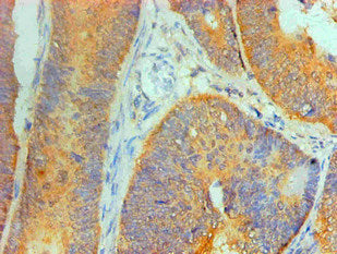 Immunohistochemical of paraffin-embedded Human Colon cancer tissue using the antibody at dilution of 1:200.