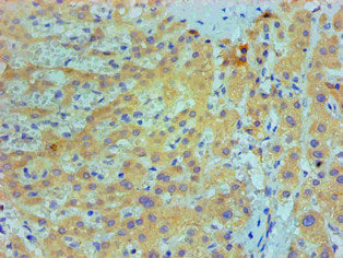 Immunohistochemical of paraffin-embedded Human live cancer tissue using  IL1F10 Monoclonal Antibody  at dilution of 1:200.mouse anti-Human IL1F10 monoclonal antibody