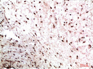 Immunohistochemical analysis of paraffin-embedded Human Colon Carcinoma Tissue using HP-1γ Mouse mAb diluted at 1:200Mouse anti-Human CBX3 Monoclonal Antibody