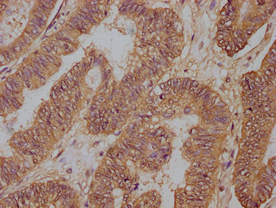 IHC image of PD-L1 Monoclonal Antibody diluted at 1:100 and staining in paraffin-embedded human colon cancer performed on a Leica BondTM system. After dewaxing and hydration, antigen retrieval was mediated by high pressure in a citrate buffer (pH 6.0). Section was blocked with 10% normal goat serum 30min at RT. Then primary antibody (1% BSA) was incubated at 4°C overnight. The primary is detected by a biotinylated secondary antibody and visualized using an HRP conjugated SP system.Mouse anti-Human PD-L1 Monoclonal Antibody
