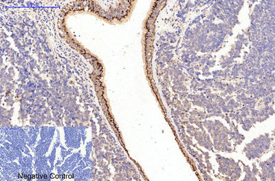 Immunohistochemical analysis of paraffin-embedded Human-lung-cancer tissue. COL1A1 Antibody was diluted at 1:200.Mouse anti-Human COL1A1 Monoclonal Antibody