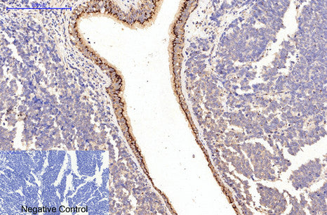 Immunohistochemical analysis of paraffin-embedded Human-lung-cancer tissue. COL1A1 Antibody was diluted at 1:200.Mouse anti-Human COL1A1 Monoclonal Antibody