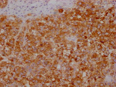 IHC image of CEACAM5 Monoclonal Antibody diluted at 1:100 and staining in paraffin-embedded human colon cancer performed on a Leica BondTM system. After dewaxing and hydration, antigen retrieval was mediated by high pressure in a citrate buffer (pH 6.0). Section was blocked with 10% normal goat serum 30min at RT. Then primary antibody (1% BSA) was incubated at 4°C overnight. The primary is detected by a Goat anti-mouse IgG polymer labeled by HRP and visualized using 0.05% DAB.Mouse anti-Human CEACAM5 Monoclonal antibody