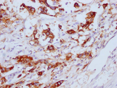 IHC image of CEACAM5 Monoclonal Antibody diluted at 1:100 and staining in paraffin-embedded human gastric cancer performed on a Leica BondTM system. After dewaxing and hydration, antigen retrieval was mediated by high pressure in a citrate buffer (pH 6.0). Section was blocked with 10% normal goat serum 30min at RT. Then primary antibody (1% BSA) was incubated at 4°C overnight. The primary is detected by a Goat anti-mouse IgG polymer labeled by HRP and visualized using 0.05% DAB.Mouse anti-Human CEACAM5 Monoclonal antibody