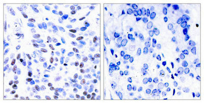Immunohistochemical analysis of paraffin-embedded human breast carcinoma tissue using NFkB-p100(Ab-866) Antibody(left) or the same antibody preincubated with blocking peptide(right).Rabbit anti-Human NFKB2 Polyclonal Antibody