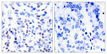 Immunohistochemical analysis of paraffin-embedded human breast carcinoma tissue using NFkB-p100(Ab-866) Antibody(left) or the same antibody preincubated with blocking peptide(right).Rabbit anti-Human NFKB2 Polyclonal Antibody
