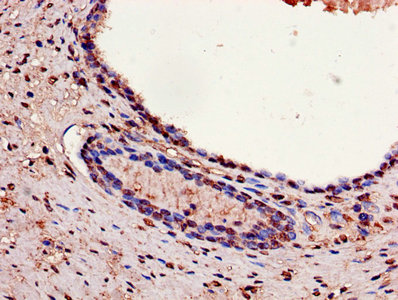 Immunohistochemistry of paraffin-embedded human prostate cancer using GAPDH Antibody at dilution of 1:100Rabbit anti-Human GAPDH Polyclonal Antibody