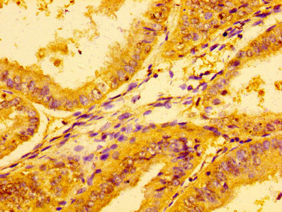 Immunohistochemistry of paraffin-embedded human endometrial cancer using LDHA Antibody at dilution of 1:100