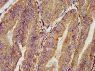 IHC image of the antibody diluted at 1:100 and staining in paraffin-embedded human endometrial cancer performed on a Leica BondTM system. After dewaxing and hydration, antigen retrieval was mediated by high pressure in a citrate buffer (pH 6.0). Section was blocked with 10% normal goat serum 30min at RT. Then primary antibody (1% BSA) was incubated at 4°C overnight. The primary is detected by a biotinylated secondary antibody and visualized using an HRP conjugated SP system.Rabbit anti-Human AARS Polyclonal Antibody