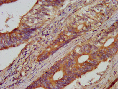 IHC image of AARS Antibody diluted at 1:100 and staining in paraffin-embedded human colon cancer performed on a Leica BondTM system. After dewaxing and hydration, antigen retrieval was mediated by high pressure in a citrate buffer (pH 6.0). Section was blocked with 10% normal goat serum 30min at RT. Then primary antibody (1% BSA) was incubated at 4°C overnight. The primary is detected by a biotinylated secondary antibody and visualized using an HRP conjugated SP system.Rabbit anti-Human AARS Polyclonal Antibody
