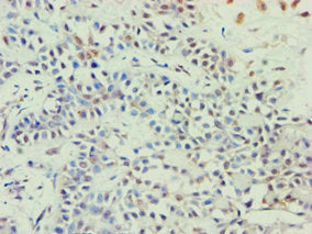 Immunohistochemistry of paraffin-embedded human breast cancer using ABCE1 Antibody at dilution of 1:100