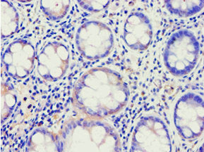 Immunohistochemistry of paraffin-embedded human colon cancer using ABCE1 Antibody at dilution of 1:100