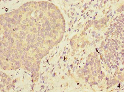 Immunohistochemistry of paraffin-embedded human gastric cancer using ABHD2 Antibody at dilution of 1:100
