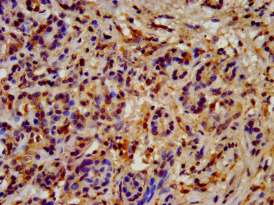 IHC image of HSP90AB1 Antibody diluted at 1:200 and staining in paraffin-embedded human pancreatic cancer performed on a Leica BondTM system. After dewaxing and hydration, antigen retrieval was mediated by high pressure in a citrate buffer (pH 6.0). Section was blocked with 10% normal goat serum 30min at RT. Then primary antibody (1% BSA) was incubated at 4°C overnight. The primary is detected by a biotinylated secondary antibody and visualized using an HRP conjugated SP system.Rabbit anti-Human HSP90AB1 Polyclonal Antibody
