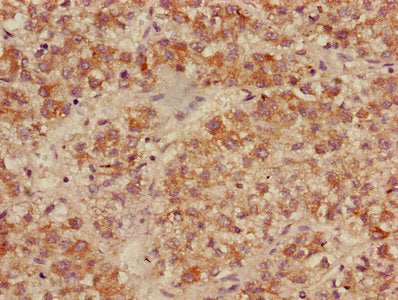Immunohistochemistry of paraffin-embedded human liver cancer using ACADL Antibody at dilution of 1:100