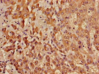 Immunohistochemistry of paraffin-embedded human liver tissue using ACADL Antibody at dilution of 1:100