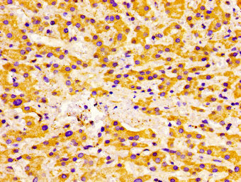 Immunohistochemistry of paraffin-embedded human liver cancer using ACADVL Antibody at dilution of 1:100