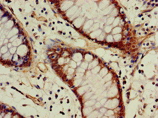 Immunohistochemistry of paraffin-embedded human colon cancer using ACAT1 Antibody at dilution of 1:100
