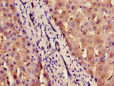 Immunohistochemistry of paraffin-embedded human liver tissue using ILF2 Antibody at dilution of 1:100Rabbit anti-Human ILF2 Polyclonal Antibody