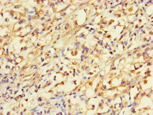 Immunohistochemistry of paraffin-embedded human gastric cancer using the antibody at dilution of 1:100