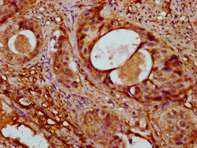 IHC image of the antibody diluted at 1:400 and staining in paraffin-embedded human cervical cancer performed on a Leica BondTM system. After dewaxing and hydration, antigen retrieval was mediated by high pressure in a citrate buffer (pH 6.0). Section was blocked with 10% normal goat serum 30min at RT. Then primary antibody (1% BSA) was incubated at 4°C overnight. The primary is detected by a biotinylated secondary antibody and visualized using an HRP conjugated SP system.