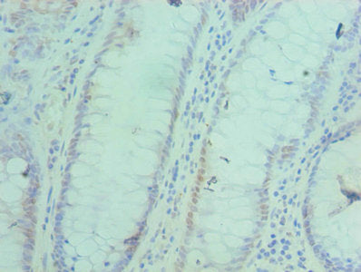 Immunohistochemistry of paraffin-embedded human colon cancer using ACTL6A Antibody at dilution of 1:100