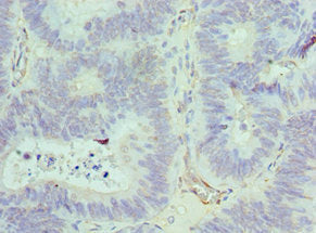 Immunohistochemistry of paraffin-embedded human colon cancer using ACTR1A Antibody at dilution of 1:100