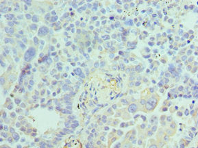 Immunohistochemistry of paraffin-embedded human lung cancer using ACTR1A Antibody at dilution of 1:100