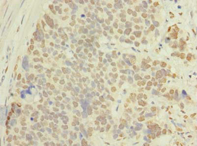 Immunohistochemistry of paraffin-embedded human gastric cancer using ACTRT1 Antibody at dilution of 1:100Rabbit anti-Human ACTRT1 Polyclonal Antibody