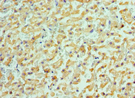 Immunohistochemistry of paraffin-embedded human liver cancer using ACVR2A Antibody at dilution of 1:100Rabbit anti-Human ACVR2A Polyclonal Antibody