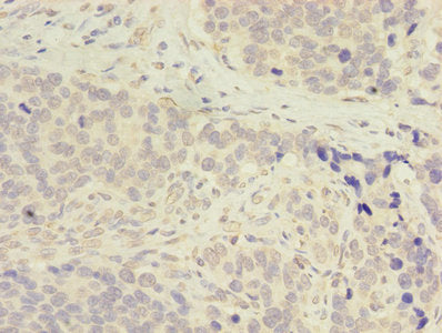 Immunohistochemistry of paraffin-embedded human gastric cancer using ADA Antibody at dilution of 1:100Rabbit anti-Human ADA Polyclonal Antibody