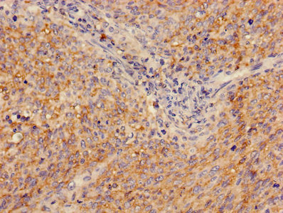 Immunohistochemistry of paraffin-embedded human cervical cancer using ADA Antibody at dilution of 1:100Rabbit anti-Human ADA Polyclonal Antibody
