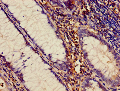 Immunohistochemistry of paraffin-embedded human colon cancer using ADAM10 Antibody at dilution of 1:100