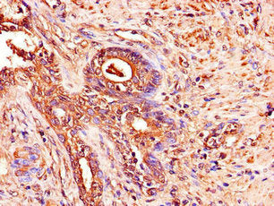 Immunohistochemistry of paraffin-embedded human prostate cancer using ADAM12 Antibody at dilution of 1:100