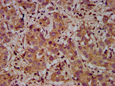 IHC image of ADAM23 Antibody diluted at 1:400 and staining in paraffin-embedded human liver cancer performed on a Leica BondTM system. After dewaxing and hydration, antigen retrieval was mediated by high pressure in a citrate buffer (pH 6.0). Section was blocked with 10% normal goat serum 30min at RT. Then primary antibody (1% BSA) was incubated at 4°C overnight. The primary is detected by a biotinylated secondary antibody and visualized using an HRP conjugated SP system.Rabbit anti-Human ADAM23 Polyclonal Antibody