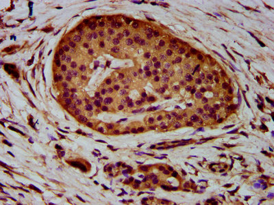 IHC image of ADAM23 Antibody diluted at 1:400 and staining in paraffin-embedded human pancreatic cancer performed on a Leica BondTM system. After dewaxing and hydration, antigen retrieval was mediated by high pressure in a citrate buffer (pH 6.0). Section was blocked with 10% normal goat serum 30min at RT. Then primary antibody (1% BSA) was incubated at 4°C overnight. The primary is detected by a biotinylated secondary antibody and visualized using an HRP conjugated SP system.Rabbit anti-Human ADAM23 Polyclonal Antibody