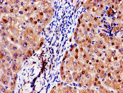 Immunohistochemistry of paraffin-embedded human liver tissue using ADAMTS4 Antibody at dilution of 1:100Rabbit anti-Human ADAMTS4 Polyclonal Antibody