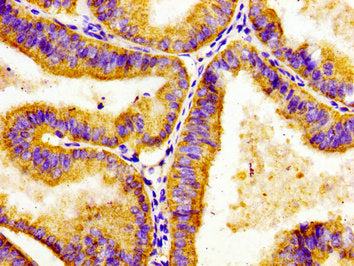 Immunohistochemistry of paraffin-embedded human endometrial cancer using ADCY8 Antibody at dilution of 1:100Rabbit anti-Human ADCY8 Polyclonal Antibody