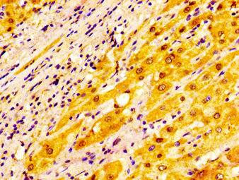 IHC image of ADH1A Antibody diluted at 1:200 and staining in paraffin-embedded human liver cancer performed on a Leica BondTM system. After dewaxing and hydration, antigen retrieval was mediated by high pressure in a citrate buffer (pH 6.0). Section was blocked with 10% normal goat serum 30min at RT. Then primary antibody (1% BSA) was incubated at 4°C overnight. The primary is detected by a biotinylated secondary antibody and visualized using an HRP conjugated SP system.Rabbit anti-Human ADH1A Polyclonal Antibody